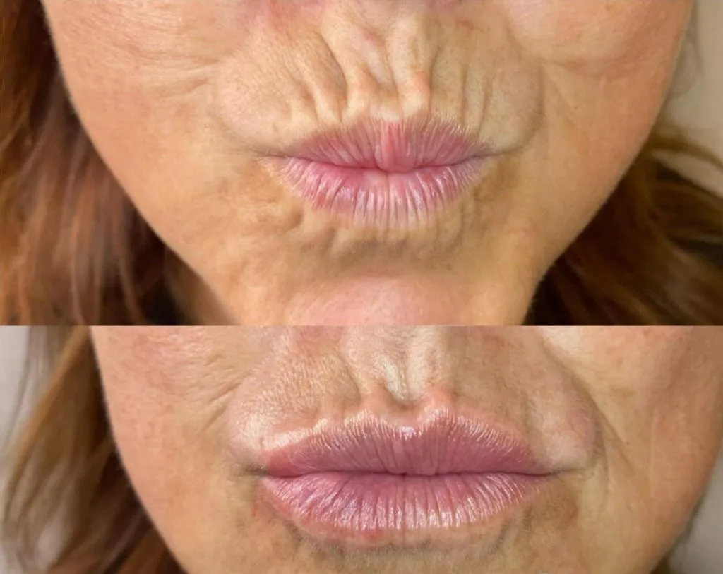 rokerslijntjesvoorna2