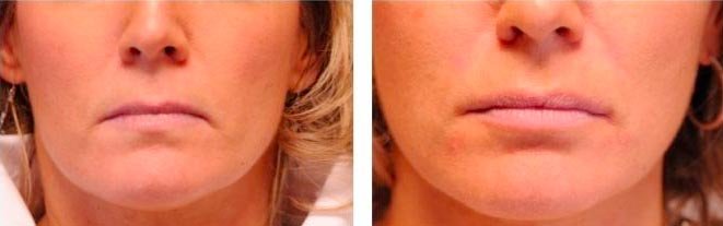 afhangendemondhoeken-4