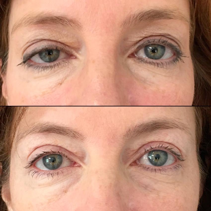 wenkbrauwlift-3